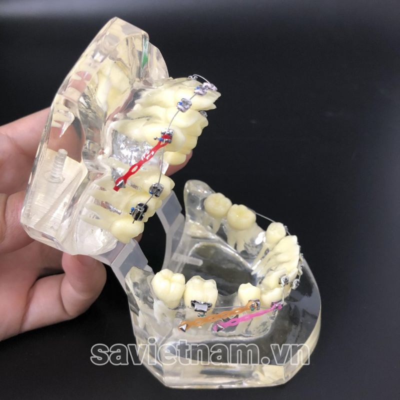 Hàm tư vấn chỉnh nha full khí cụ có nhổ răng trong nha khoa