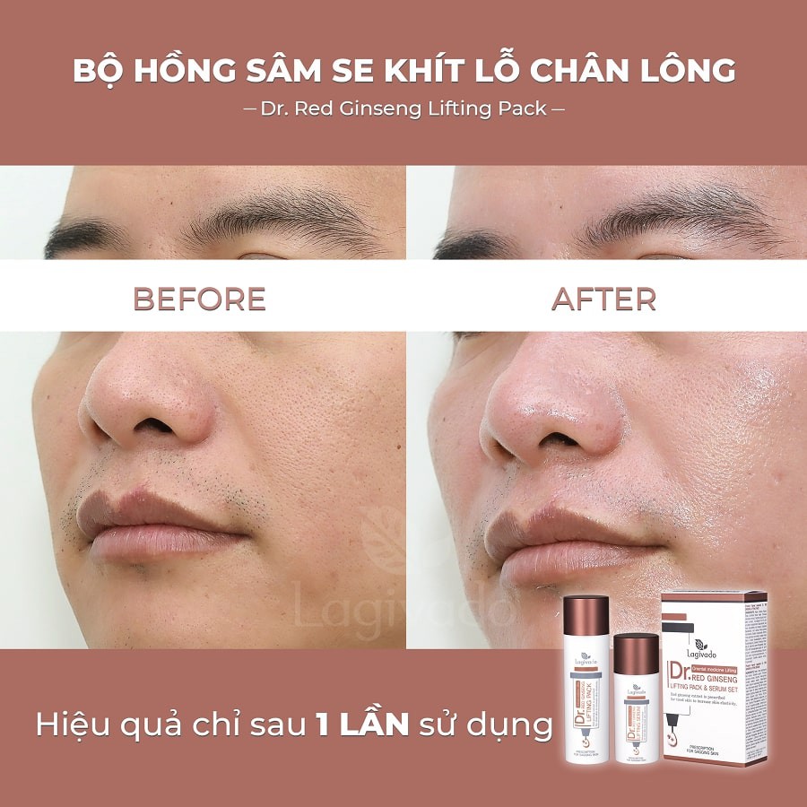 Bộ chăm sóc da giảm mụn đầu đen Hàn Quốc Lagivado thu nhỏ lỗ chân lông gồm mặt nạ hồng sâm 50 ml + serum 30 ml.