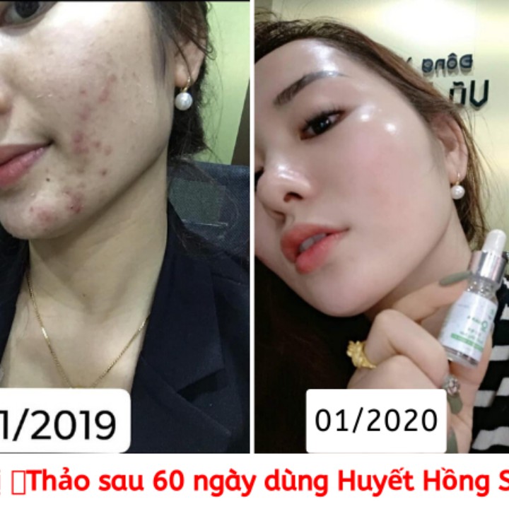 Serum Trị Mụn Cao Cấp 💖FREESHIP💖 Huyết Hồng Sâm Trị Mụn | Trị thâm | Mờ sẹo Rỗ Se Khít Lỗ Chân Lông | BigBuy360 - bigbuy360.vn