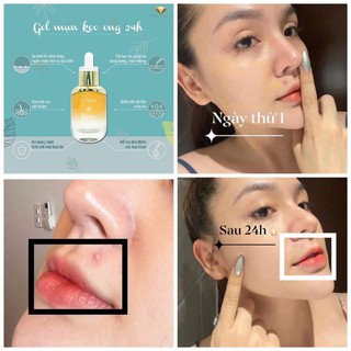 GEL MỤN KEO ONG