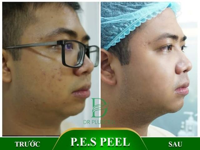 [TRỢ GIÁ] Bộ 2 Pes peel mụn Dr Pluscell