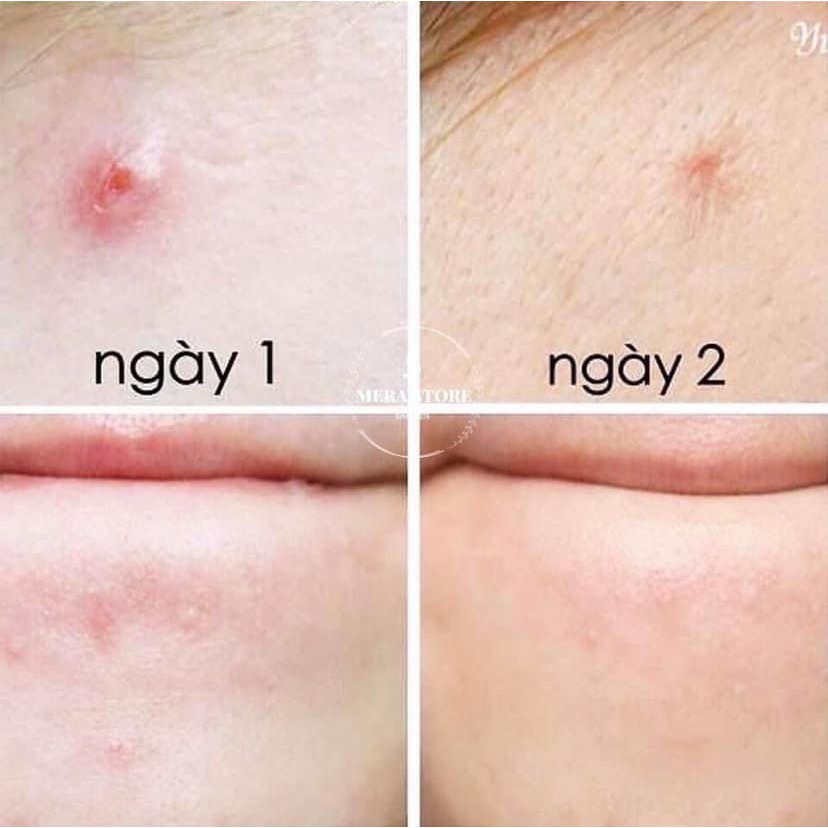 [BILL] Gel Chấm Mụn Tea Tree Blemish Gel - The Body Shop | BigBuy360 - bigbuy360.vn