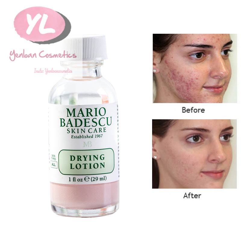 [Bill Auth] Set dưỡng da chấm mụn 3 món Mario Badescu Acne Repair Kit ( Drying lotion, Buffering Lotion, Drying Cream)