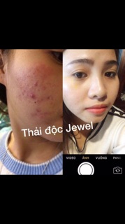Thải độc jewel
