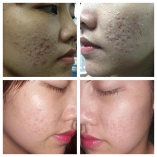 KEM TRỊ MỤN PAIR