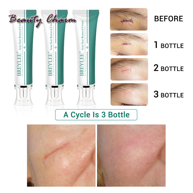 [Hàng mới về] Kem Hỗ Trợ Giảm sẹo 30ml chuyên dụng | BigBuy360 - bigbuy360.vn