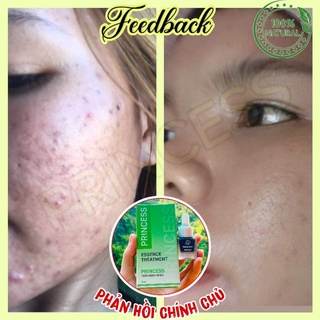 Serum l princess vua diệt mụn chính hãng
