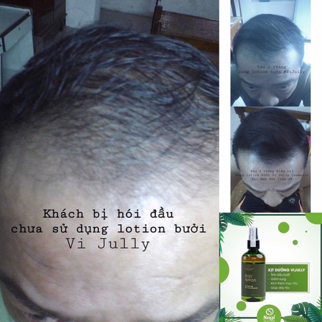 [Chính hãng] Tinh dầu bưởi vijully mọc tóc nhanh, từ thiên nhiên, dùng được cho cả nam và nữ | BigBuy360 - bigbuy360.vn