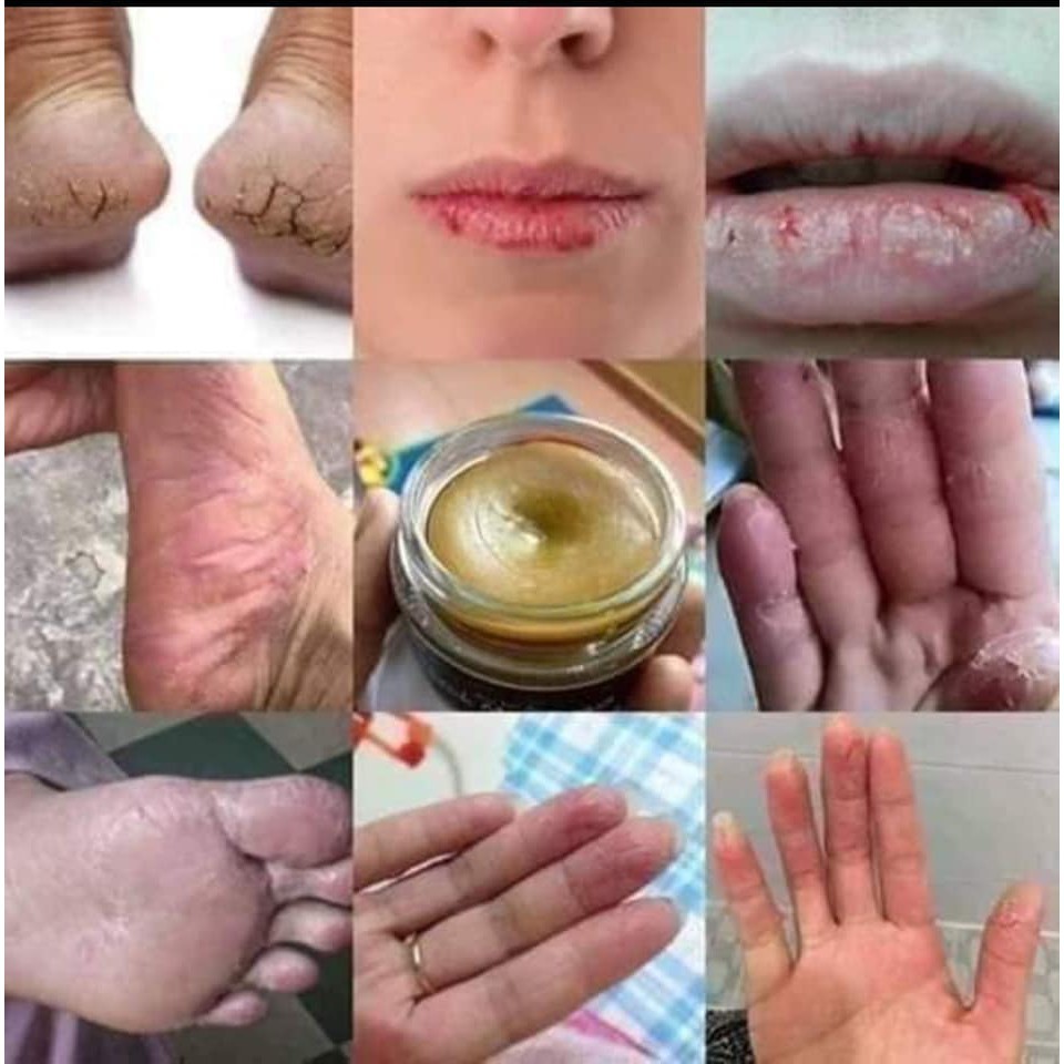 [Chính Hãng] Bôi da - Cao bôi khô da nhiệt miệng | BigBuy360 - bigbuy360.vn