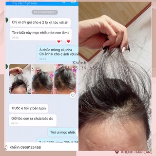 COMBO HỖ TRỢ MỌC TÓC, HỖ TRỢ GIẢM RỤNG