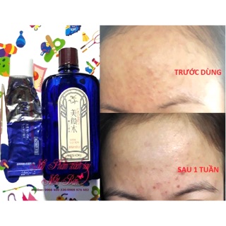 Nước hoa hồng trị mụn bigansui và kem trị mụn pair