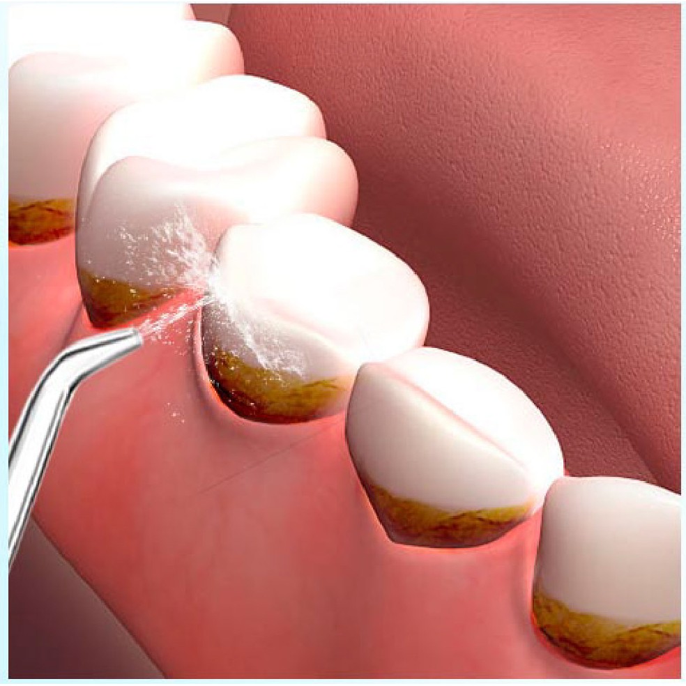 Đầu tăm nước tiêu chuẩn h2ofloss