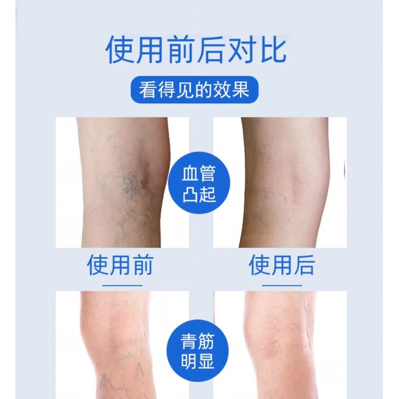 Dược liệu suy giãn tĩnh mạch