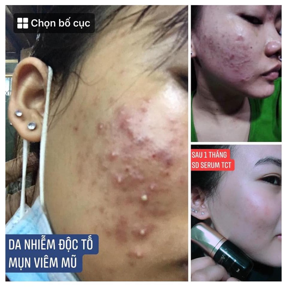 Serum Trứng Cá Tuyết Dermapeel+ 7ml - Sạch Mụn - Kiểm Soát Nhờn - Se Khít Lỗ Chân Lông - Chống Lão Hóa - Trắng Sáng | BigBuy360 - bigbuy360.vn