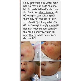 kem chàm, nẻ Dyxeryl