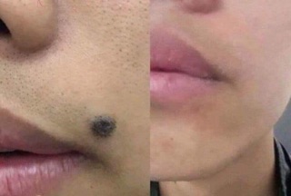 Tẩy mụn ruồi Nga