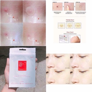 Miếng dán mụn Cosrx Acne Pimple Master Patch