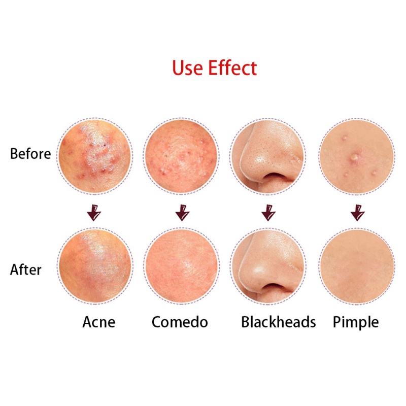 Dụng Cụ Nặn Mụn Hai Đầu Bằng Thép Không Gỉ YOUYO