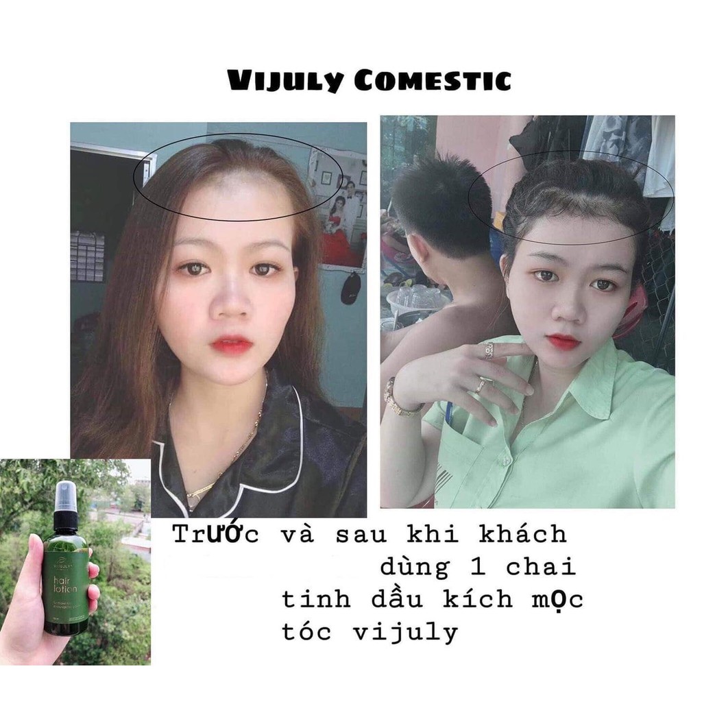 [TẶNG CỘT TÓC XINH] Tinh dầu bưởi VIJULLY NGĂN RỤNG TÓC MỌC TÓC NHANH HIỆU QUẢ SAU 2 TUẦN 100ml/1chai