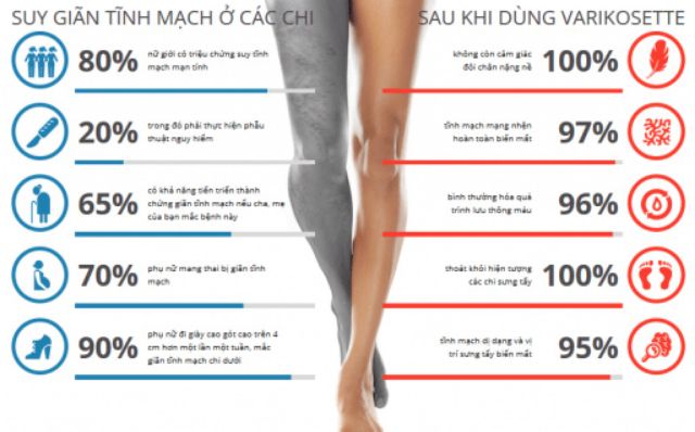 KEM VARIKOSETTE suy giản tỉnh mạch