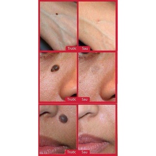 Tẩy nốt RUỒI NGA