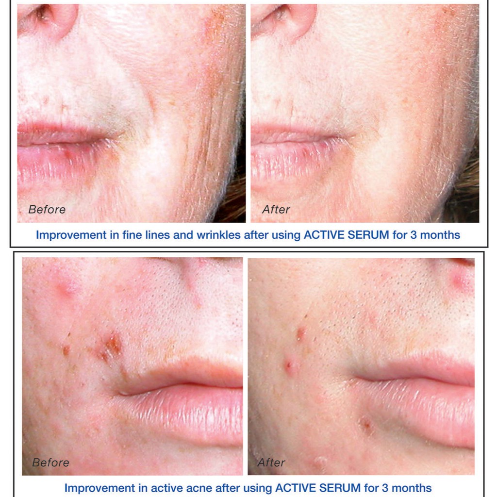 Tinh chất dưỡng da dầu mụn iS Clinical Active Serum