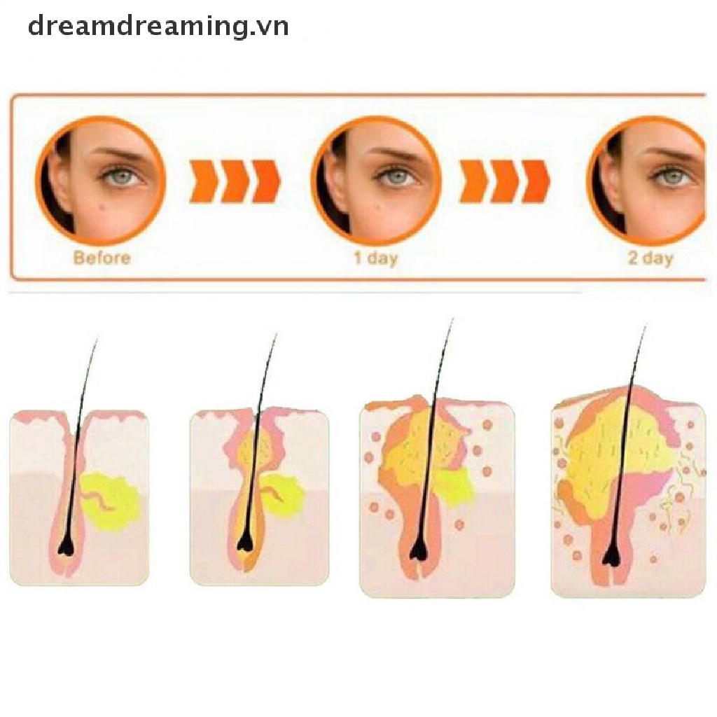 Bộ 36 Miếng Dán Hỗ trợ giảm mụn Tiện Dụng