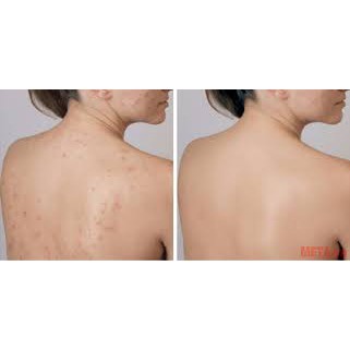 Bàn chải khô tẩy da chết the body shop round body brush