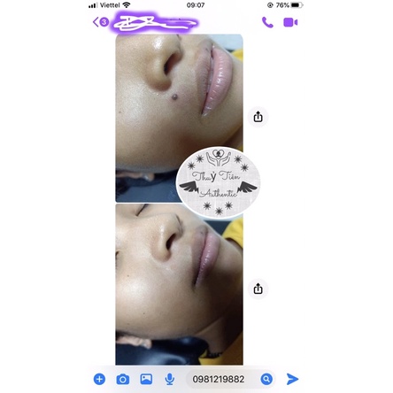 Gel tẩy mụn ruồi,mụn cóc, mụn cơm,tàn nhang | BigBuy360 - bigbuy360.vn