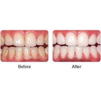 Tẩy trắng răng tại nhà Opalescence 20%/ 35%