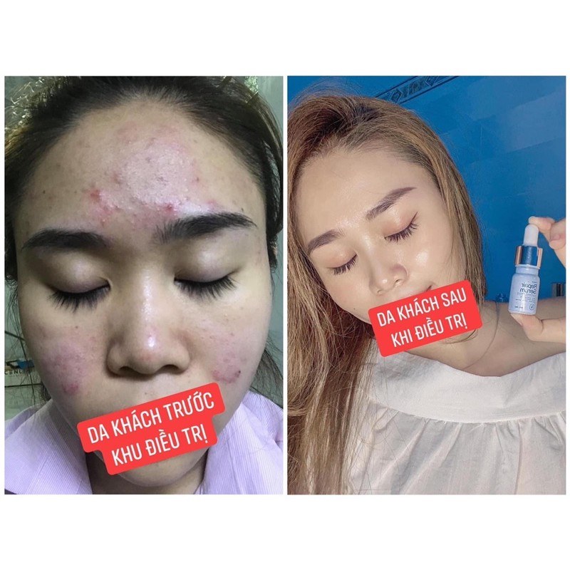 Serum rễ cây mật gấu CENLIA 🔥[ CHÍNH HÃNG ]🔥 trả lại làm da mịn màng sạch mụn, không để lại sẹo thâm