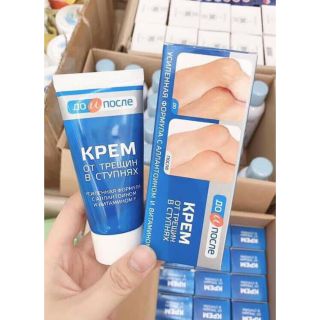 KEM TRỊ NẺ NỨT GÓT CHÂN NGA KPEM