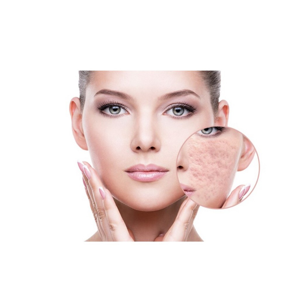 Kem MỜ THÂM SẸO SmoothE Natural Source Nhật Bản Chính Hãng tuýp 15g