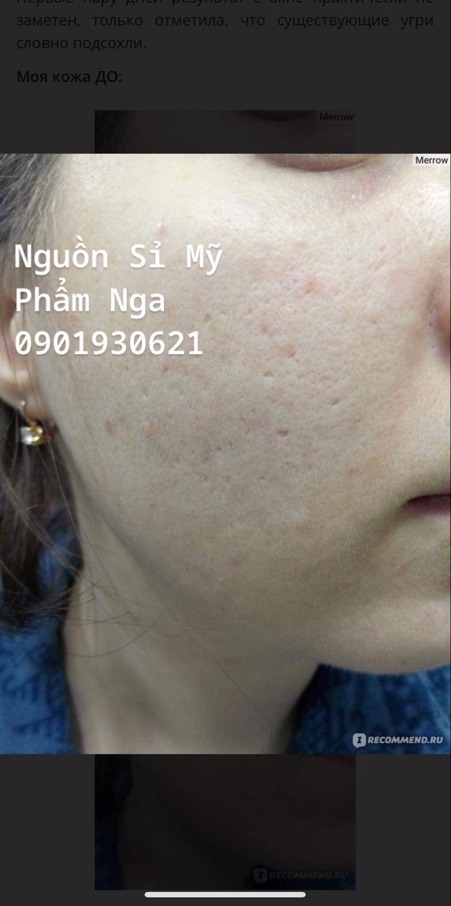 Serum TEANA SUPER PEPTIDES hổ trợ mụn 10 ống 2ml