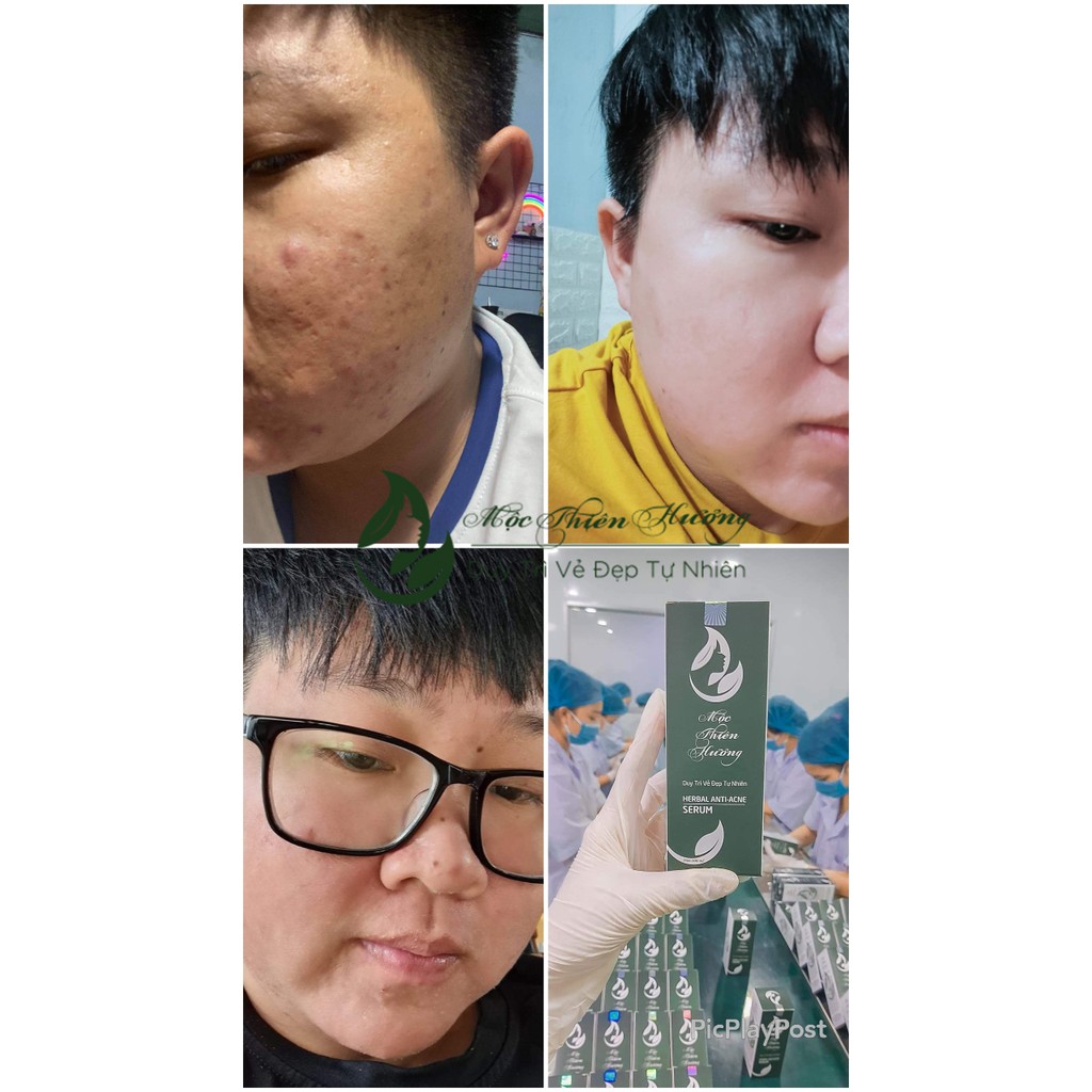 Combo Đánh Bay Nhanh Mụn Viêm, Mụn Ẩn, Mụn Trứng Cá, Mụn Đầu Đen Và Các Loại Mụn Khác Mộc Thiên Hương | BigBuy360 - bigbuy360.vn