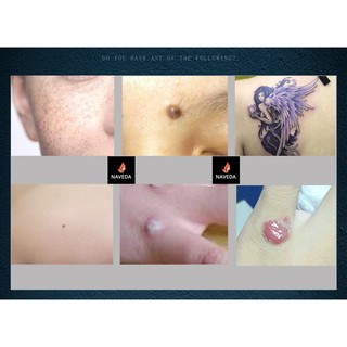 MÁY ĐỐT NỐT RUỒI, MỤN THỊT, XÓA XĂM