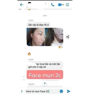 COMBO 5 HỘP KEM MỤN TRẮNG DA 2C