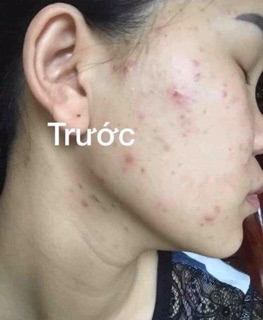 Sửa rữa mặt colagen X3