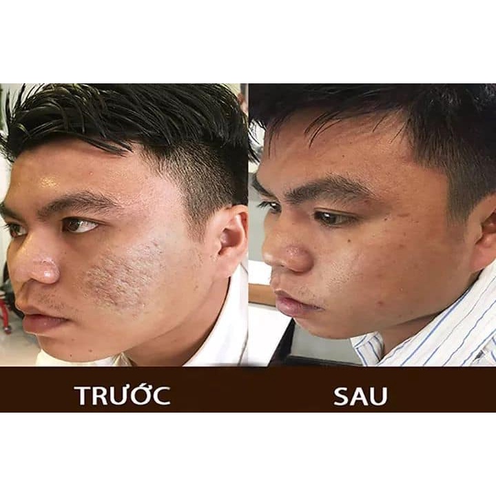"GIÁ SỐC" Kem sẹo rỗ, sẹo thâm, sẹo rạn , sẹo thủy đậu