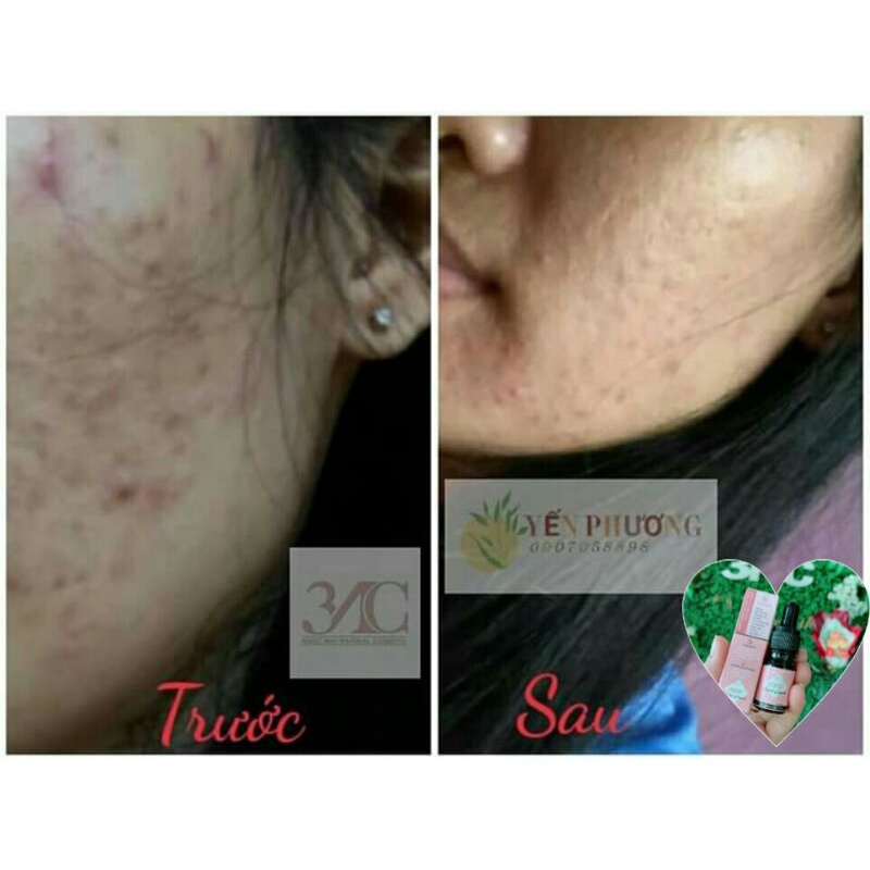 Trị_mụn_coco+_3NC