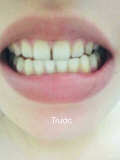 ❌ BỘT TRẮNG RĂNG THAN TRE HOẠT TÍNH WEBIG
