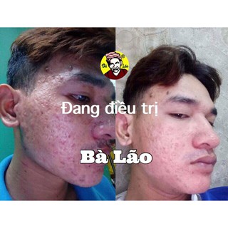Serum Mụn Sẹo Nám Da Hoả Tốc Bà Lão