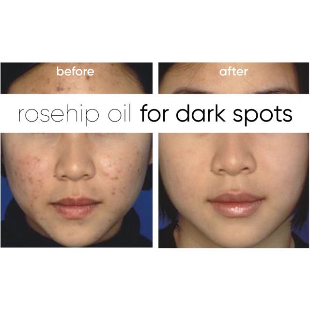 Tinh dầu nụ tầm xuân ngăn ngừa và giảm thâm mụn rosehip now  - Chính hãng