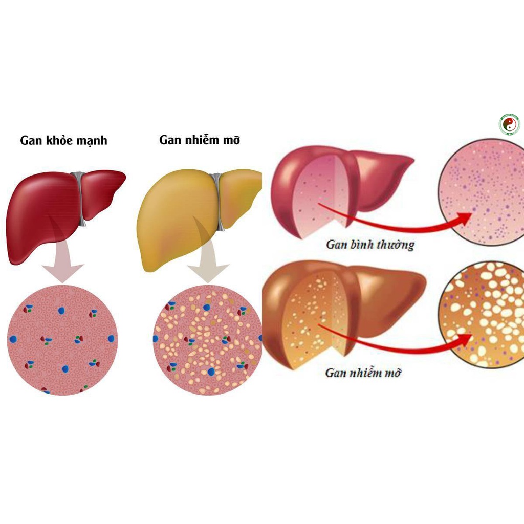 Giải Độc Gan Hạ Men Gan - Giải Độc Cơ Thể - Thải Độc Gan Nhiễm Mỡ