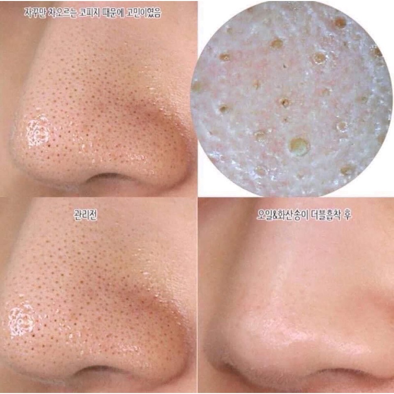 THANH LĂN MỤN MAMONDE SE KHÍT LỖ CHÂN LÔNG