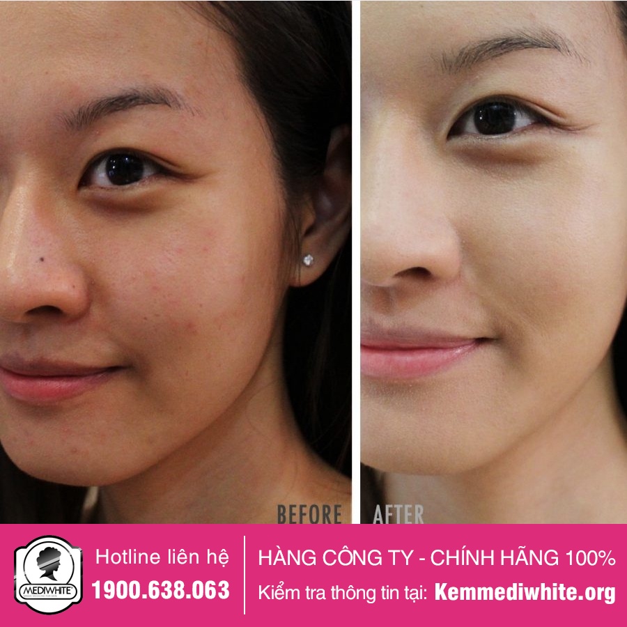 Kem Trắng Da Medi White Chính Hãng - Medi White Face - Kem Dưỡng Trắng Da Chống Lão Hóa Mờ Thâm Medi White