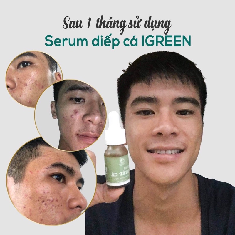 Serum giảm mụn, giảm thâm_không gây bong tróc_dị ứng mẩn ngứa, dành cho mọi loại da_da dầu mẹ bầu tặng quà