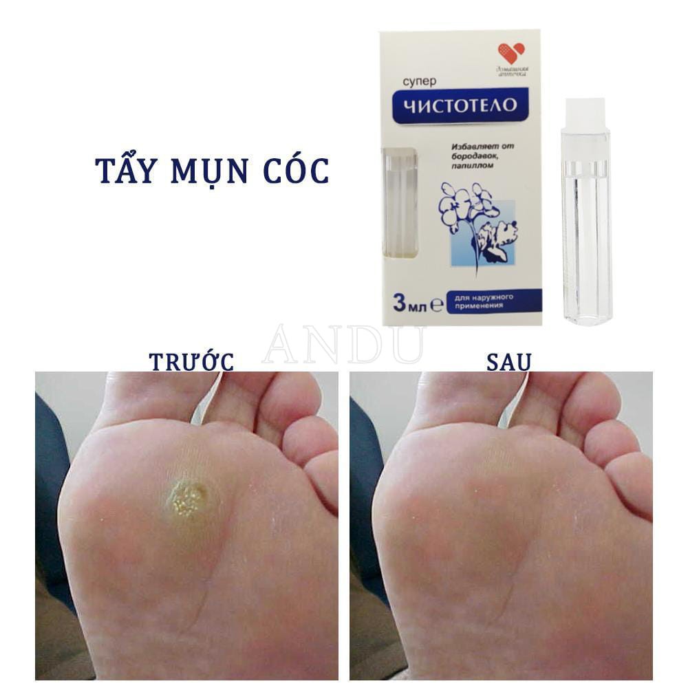 Gel Tẩy Nốt Duồi Dvelinil ,Gel Tẩy Sẹo, Tàn Nhang, Mụn Cóc , Mụn Thịt