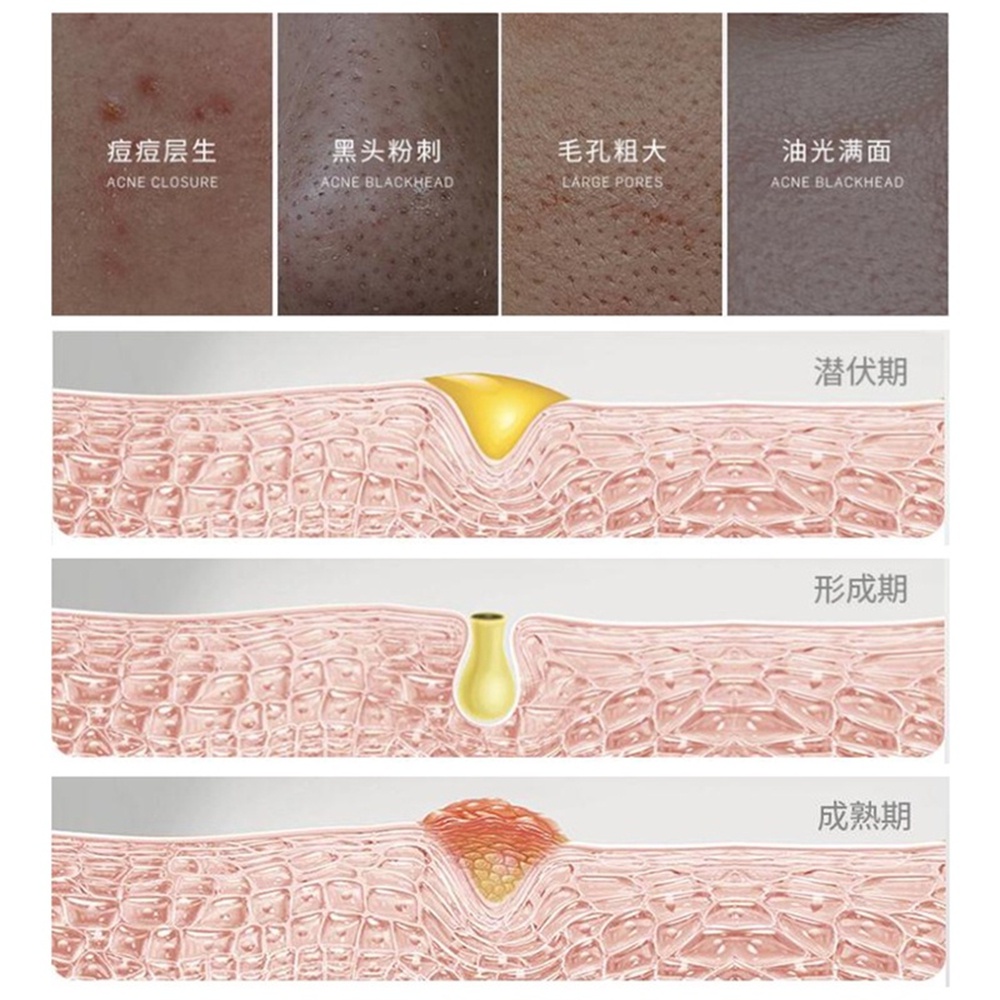 [Hàng mới về] Mặt nạ lột mụn đầu đen vùng chữ T đa năng giúp làm sạch sâu cho da mặt