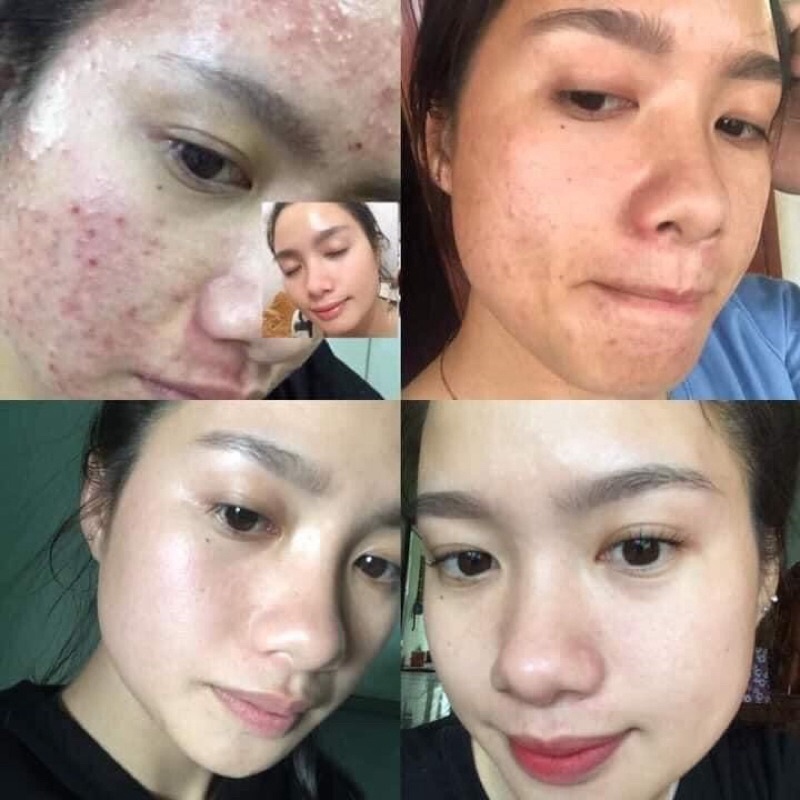 Serum CARAMEL ESSENCE Nhật Bản 5ml chính hãng, ngừa mụn xoá thâm dưỡng da mịn màng căng bóng